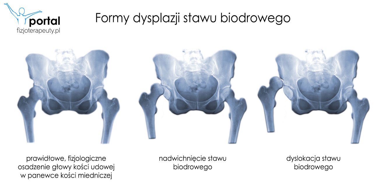 pieluchy hednorazowe hydrożelowe